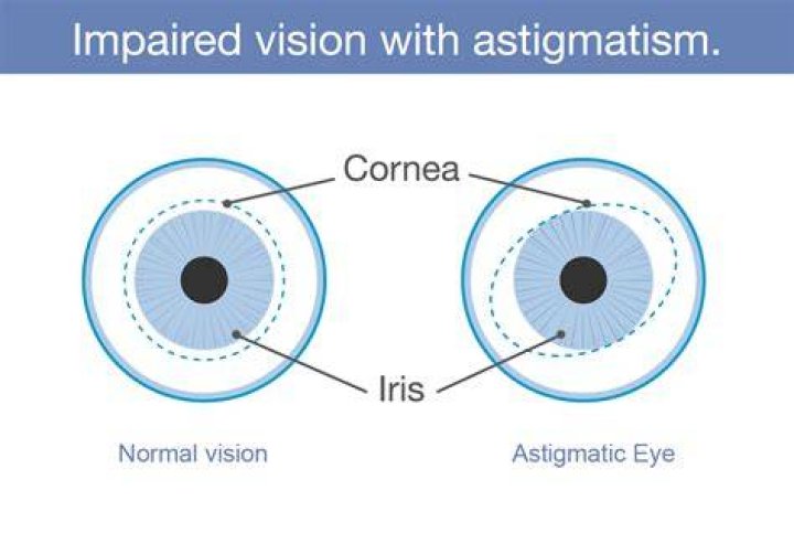 Astigmatism The Canadian Association of Optometrists