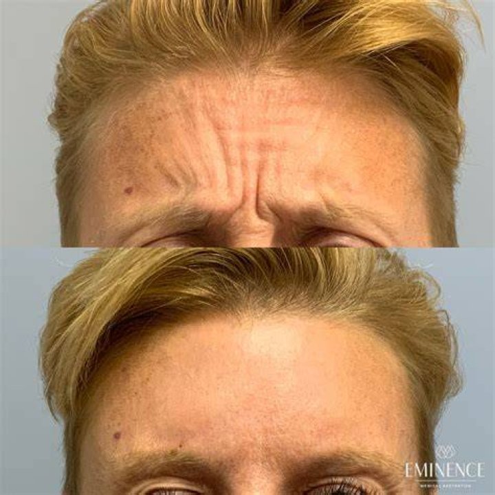 BOTOX&reg; Cosmetic Results Princeton, Montgomery NJ Eminence
