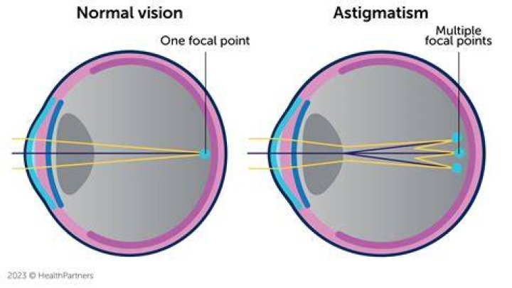 What is Astigmatism?