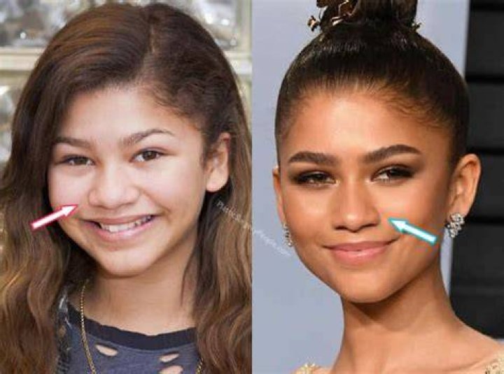 Zendaya Plastic Surgery Before and After Plastic Surgery Magazine